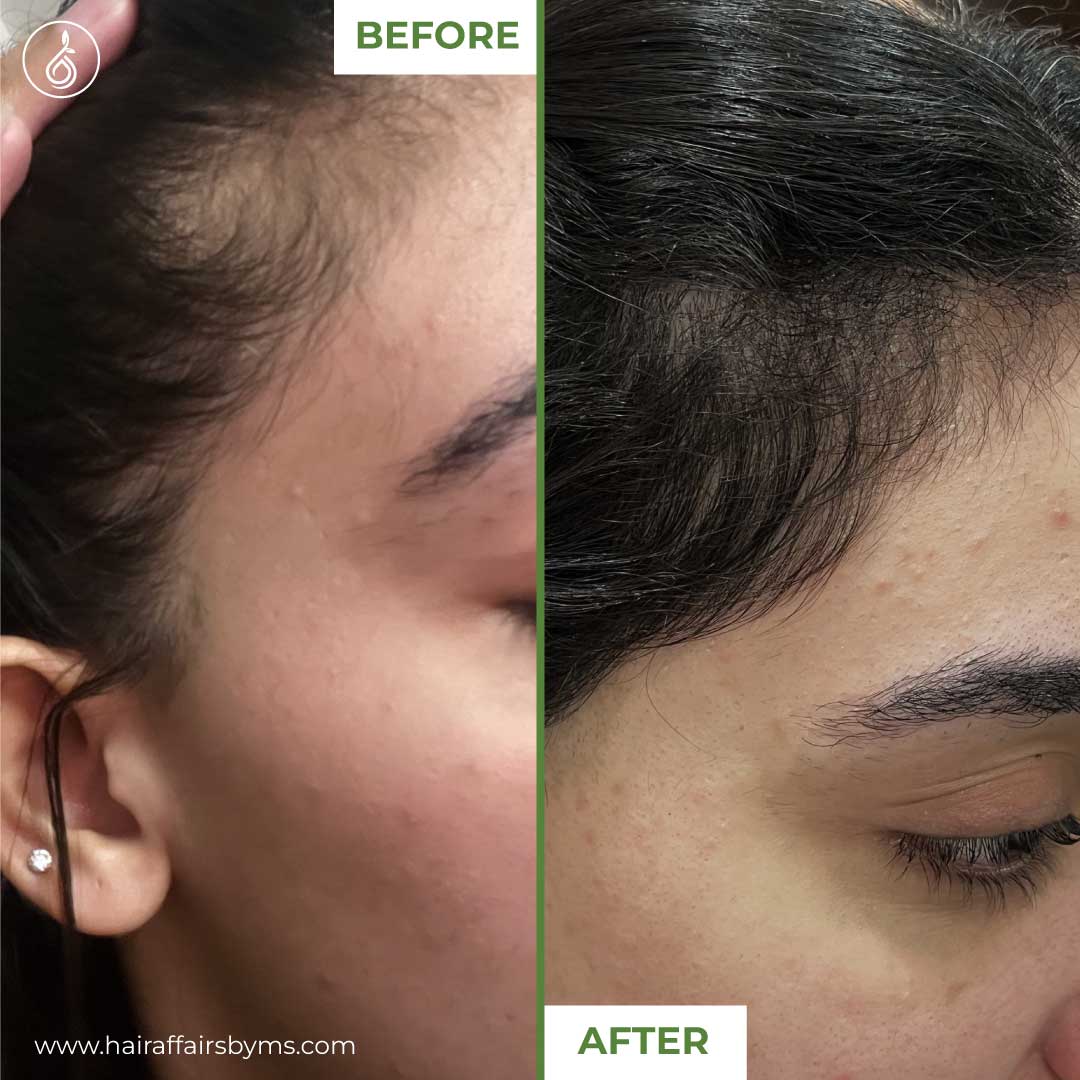 Derma Roller